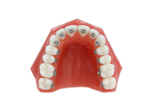 歯の裏側からの矯正装置